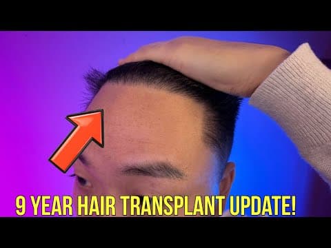 9 Year Update On My Hair Transplant!