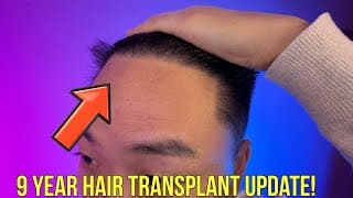 9 Year Update On My Hair Transplant!