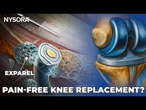 Pain-free Knee Replacement? Regional Anesthesia & Exparel® Are Changing Recovery