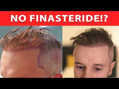 Hair Transplant Without Finasteride In 2026? Watch This First!