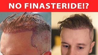 Hair Transplant Without Finasteride In 2026? Watch This First!