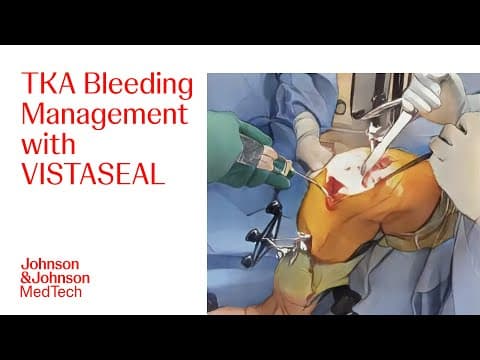 How Vistaseal Helps Control Bleeding In Total Knee Replacement Surgery | J&j Medtech
