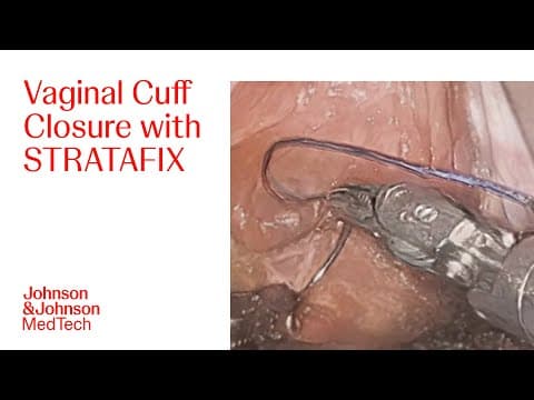 Vaginal Cuff Closure In A Robotic Hysterectomy Using Stratafix With Jonathan Black, Md | J&j Medtech