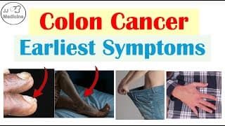 5 Early Symptoms Of Colon Cancer (colorectal Carcinoma)