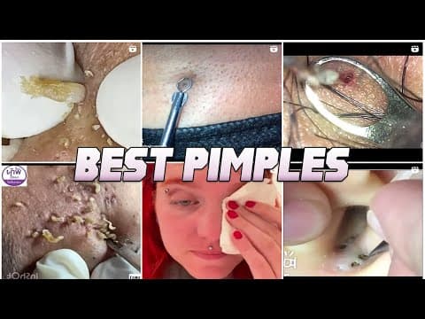 Looking For Great Pimple Popping And Great Sleep?