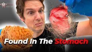 5 Shocking Things People Swallow (And What Happens)