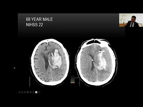 Session 3: Surgical Management Of Hemorrhagic Stroke: A Procedural Focus
