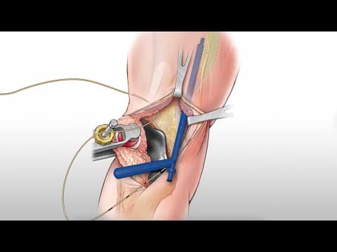 Opioid-free Knee Surgery / Surgeon-placed Adductor Canal Block