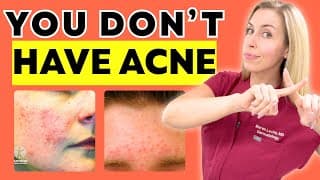 You Don't Have Acne!!! You Have This! | And How To Fix It