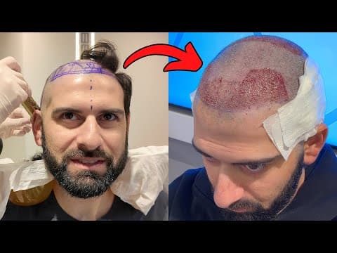 I Got A Hair Transplant In Turkey | My Full Experience