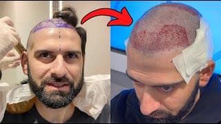 I Got A Hair Transplant In Turkey | My Full Experience