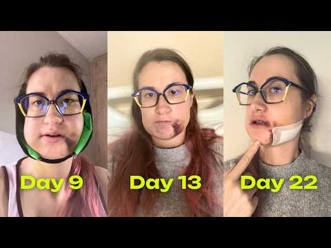Jaw Surgery Healing Process (and Unexpected News)
