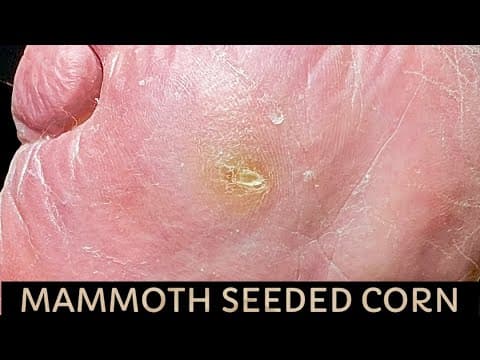 Sharp Debridement Of A Deep Wicked Corn