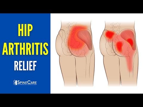 How To Relieve Hip Arthritis Pain (step-by-step Guide)