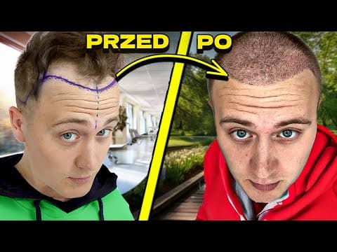 Mój Przeszczep Włosów!