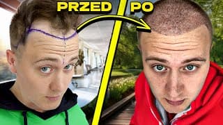 Mój Przeszczep Włosów!