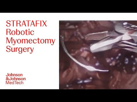 Robotic Myomectomy Surgery To Remove Fibroids Using Stratafix | J&j Medtech