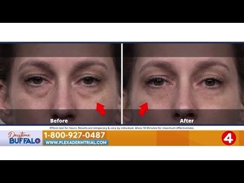 Daytime Buffalo: Plexaderm | Sponsored Segment