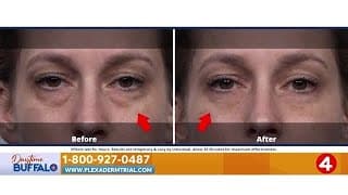 Daytime Buffalo: Plexaderm | Sponsored Segment