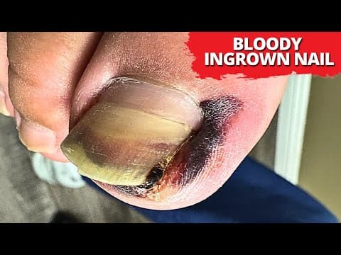 Extreme Ingrown Toenail Extraction | Bloody & Dark Nail