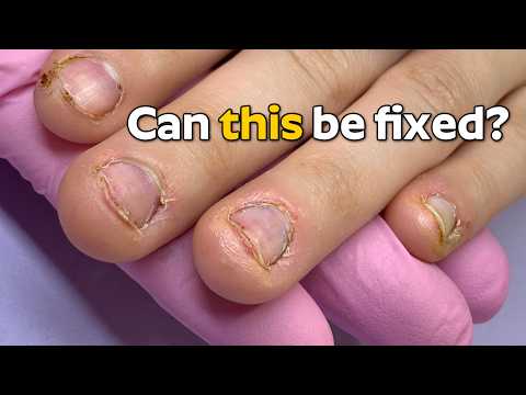 Two Nail Techs Fix Bitten Nails