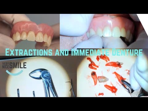 Extractions And Immediate Denture Delivery