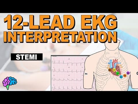 Recognize St Elevation Myocardial Infarction (stemi) On 12-lead Ekg!