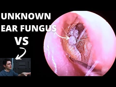 Ear Fungal Infection Vs Audiologist