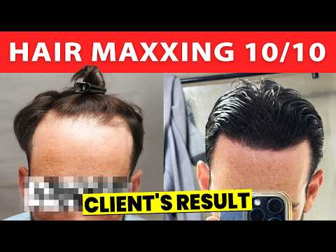 Client Got 2100 Grafts Hair Transplant For $5k