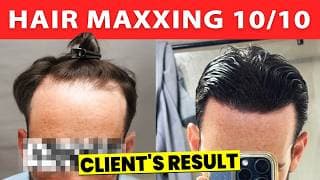 Client Got 2100 Grafts Hair Transplant For $5k