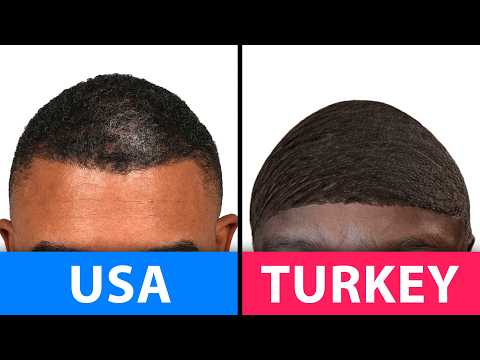 Is Turkey Really Better For A Transplant? | Hair Surgeon Reacts