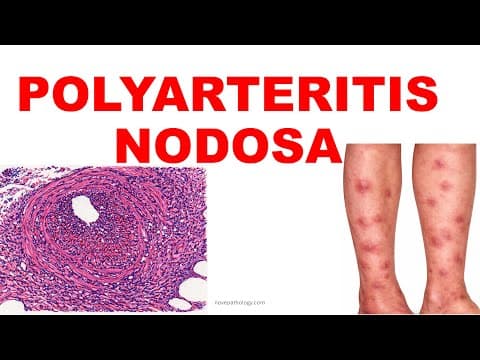 Polyarteritis Nodosa | Pathogenesis And Morphology|  Vasculitis – Part 5