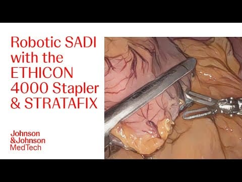 Robotic Sadi Using The Ethicon 4000 Stapler And Ethicon 3d Reloads With Dr. Roberts | J&j Medtech
