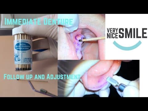 Immediate Denture Follow Up The Next Day