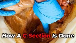 What Actually Happens During a C-Section?