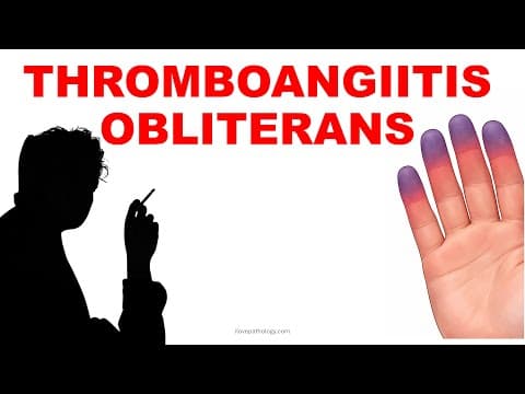 Thromboangitis Obliterans /buerger's Disease  | Pathogenesis And Morphology|  Vasculitis – Part 4