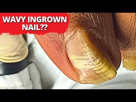 Insane Ingrown Toenail Removal On Curved, Wavy Nails?? | Must-see!