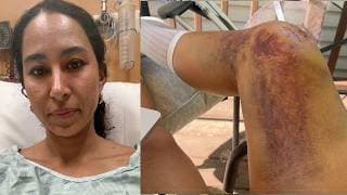 100 Days After My Crash: What No One Tells You