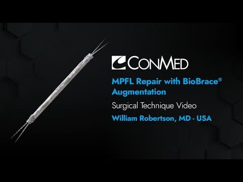 Dr. William Robertson - Mpfl Repair With Biobrace® Augmentation - Conmed Surgical Technique