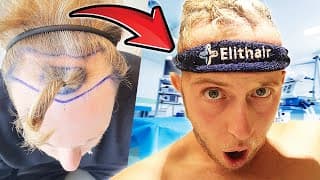 Flying To Istanbul For A Hair Transplant