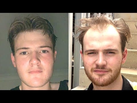 Balding At 15 - 20 Years Old
