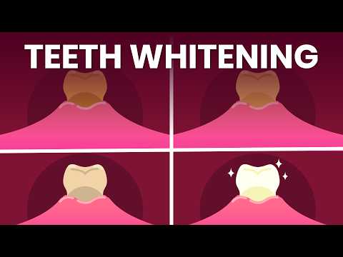 How These Substances Darkens Your Teeth | Teeth Whitening