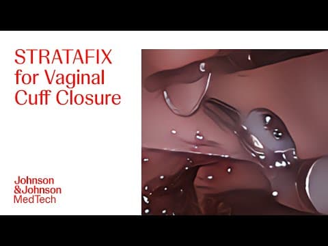 Robotic Lap Hysterectomy With Stratafix Spiral Pds Plus | J&j Medtech