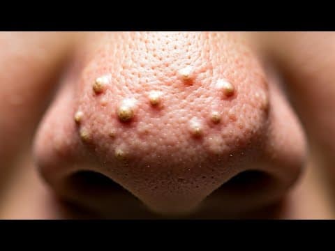 Blackhead, Blackheads And More Black Heads!  Documentary