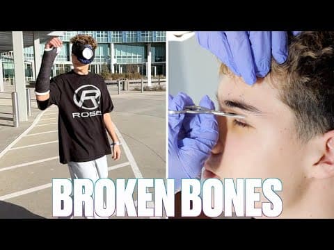 Getting A Cast Put On His Broken Arm The Same Day His Surgery Stitches Are Removed